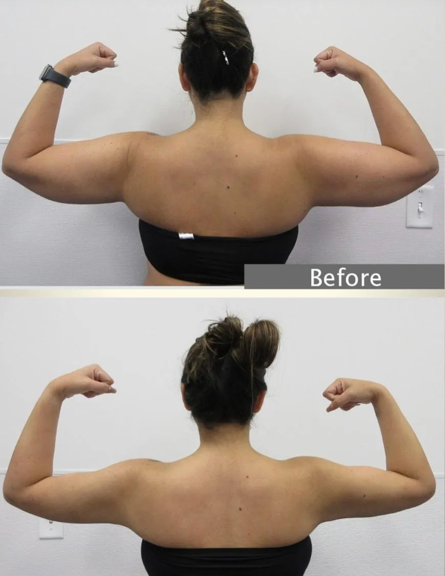 Lipœdème des bras – avant / après liposuccion WAL, photo 4